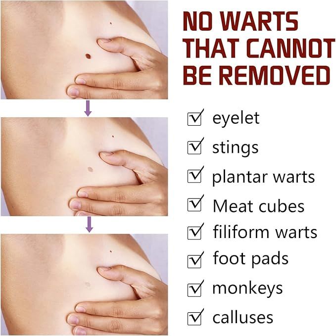 Tags &amp; Moles Remover